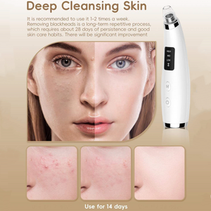 Extracteur de points noirs électrique à 5 têtes, aspirateur de pores, aspiration 53-63 KPA, batterie 400 mAh, garantie 12 mois, extracteur d'acné portable - Product Image 5