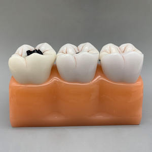 Modèle de classification de la carie dentaire quadruple Science médicale Maladie de la carie dentaire - Product Image 2