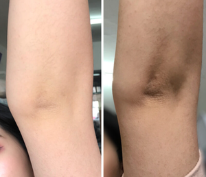 Crema Exfoliante para Eliminar <span class=keywords><strong>Cicatrices</strong></span> Antiguas en las Piernas, <span class=keywords><strong>Aceite</strong></span> Blanqueador para la Piel - Product Image 3