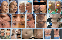 Machine de liposuccion laser hautement efficace 980nm+1470nm, lifting facial endolaser, Endo Laser Lift