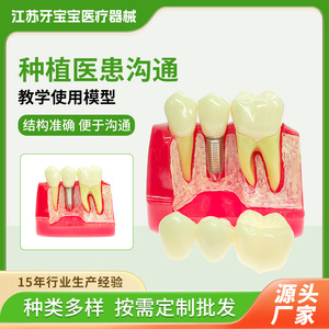Modèle dentaire, modèle pédagogique buccal, modèle d'implant dentaire détachable, modèle de communication médecin-patient, modèle de soins dentaires - Product Image 5