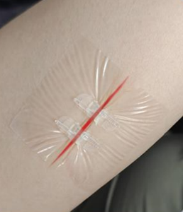 Dispositif de fermeture de plaies stérile à l'ozone de classe II, <span class=keywords><strong>Zipstitch</strong></span>, adhésif, film PU transparent de qualité médicale, matériaux polymères - Product Image 4