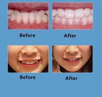 Ensemble de 3 étapes d'alignement dentaire en silicone pour enfants – Appareil orthodontique et redresseur de dents