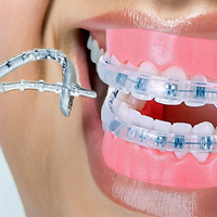 Protège-lèvres orthodontique confortable en plastique pour appareils dentaires, protège-dents, bouclier dentaire, alternative à la cire dentaire