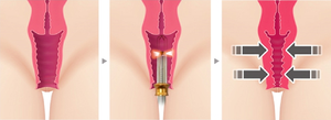 Diskon besar mesin <span class=keywords><strong>Laser</strong></span> dioda ginekologi instrumen bedah untuk peremajaan vagina peralatan <span class=keywords><strong>Laser</strong></span> - Product Image 5