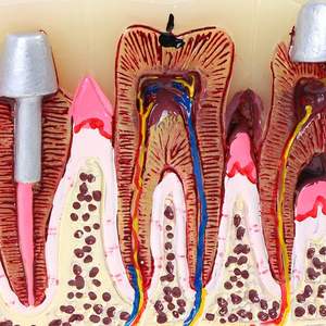 Dentiste utiliser la science médicale dents humaines résine matériel modèle de pathologie dentaire modèle complet de carie dentaire - Product Image 5