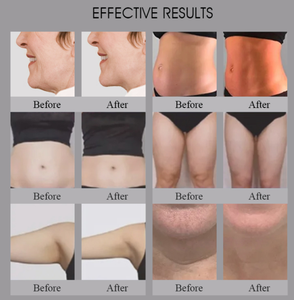 Appareil de beauté pour le raffermissement du visage et le lifting anti-rides, sculpture corporelle personnalisée, perte de graisse non chirurgicale - Product Image 6