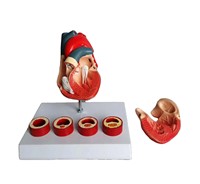 Modelo de Enseñanza Médica de Corazón con Trombosis, Simulador Realista de Patología Cardíaca para Entrenamiento de Cardiología CE/ISO