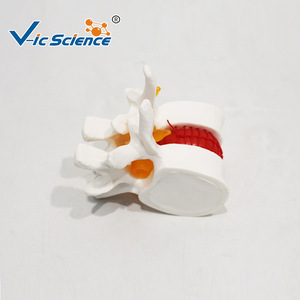Modelo de demostración de hernia de disco lumbar, esqueleto vertebral espinal médico, material didáctico de patología, venta al por mayor desde - Product Image 1