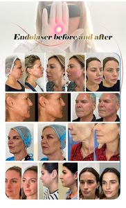 Cánulas de Liposucción, Bomba de Succión Médica, <span class=keywords><strong>Precio</strong></span>, Eliminador de Venas Varicosas, Eliminador de Venas Varicosas, Terapia Láser para Lesiones - Product Image 2