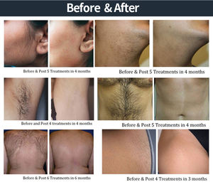 Перманентный эпилятор для удаления волос диодный лазерный 755 808 1064 оборудование OEM логотип портативный эпиляционный Окончательный - Product Image 6