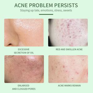 Suero Facial para el Cuidado de la Piel de 30 ml, Elimina el Acné Profundo, Aclara la Piel, con 2% de Ácido Salicílico - Product Image 3