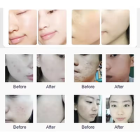 Appareil de soin du visage à jet d'oxygène 6 en 1, nettoyage en profondeur des pores, hydratation, rajeunissement de la peau, équipement de beauté pour salon