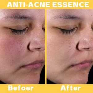 Bosman OEM Esencia antiacné de ácido salicílico Desbloquea profundamente los poros Reduce el enrojecimiento facial Hinchazón Calma la piel Esencia facial - Product Image 5