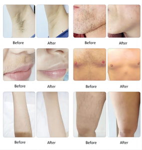 เครื่องกำจัดขน 2 in 1 พิโกวินาที 808 ไดโอดเลเซอร์ กำจัดขน กำจัดรอยสัก ผลิตภัณฑ์ดูแลความงามส่วนบุคคล - Product Image 6