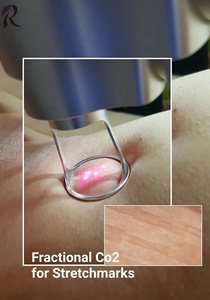 Máquina de Láser Fraccional de CO2 con Brazo Articulado para Rejuvenecimiento Facial, Antienvejecimiento y Rejuvenecimiento Vaginal - Product Image 3