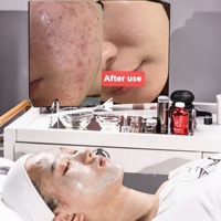 Kit Facial Équilibrant pour la Peau aux Probiotiques Complexes, Traitement de l'Acné Cystique à Base de Lactobacillus Ferment et d'Acides Aminés, Soin du Microbiome Cutané