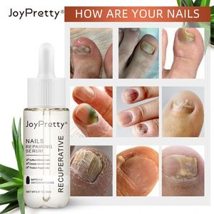 AUQUEST Tratamiento de hongos Suero Reparación de pies Esencia Cuidado Blanqueamiento Dedo del pie Gel de eliminación de hongos en las uñas Anti Infección 20ml - Product Image 2