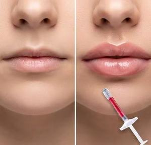 <span class=keywords><strong>Injection</strong></span> de comblement cutané à l'acide hyaluronique, formule avancée pour une amélioration naturelle et une mise en forme précise - Product Image 1