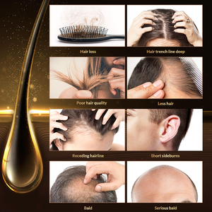 Yunnan-Muestra de balala, el <span class=keywords><strong>mejor</strong></span> <span class=keywords><strong>tratamiento</strong></span> para la pérdida de cabello para un crecimiento más rápido del cabello, suero para el crecimiento del cabello 100% Natural omy lady - Product Image 4