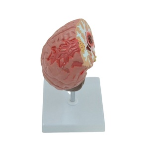 Modelos anatómicos cerebrales patológicos Hemorragia cerebral, tumores y modelo de enfermedad cerebral por accidente cerebrovascular - Product Image 3