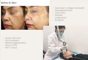 Láser Nd:YAG pulsado Q-Switched de alta eficiencia 1064nm/532nm, equipo de belleza profesional para eliminación de cicatrices y tatuajes para uso comercial - Product Image 3