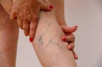 Chirurgie Laser pour les varices EVLT/EVLA diode laser 980nm portable traitement laser des varices des jambes dispositif approuvé CE