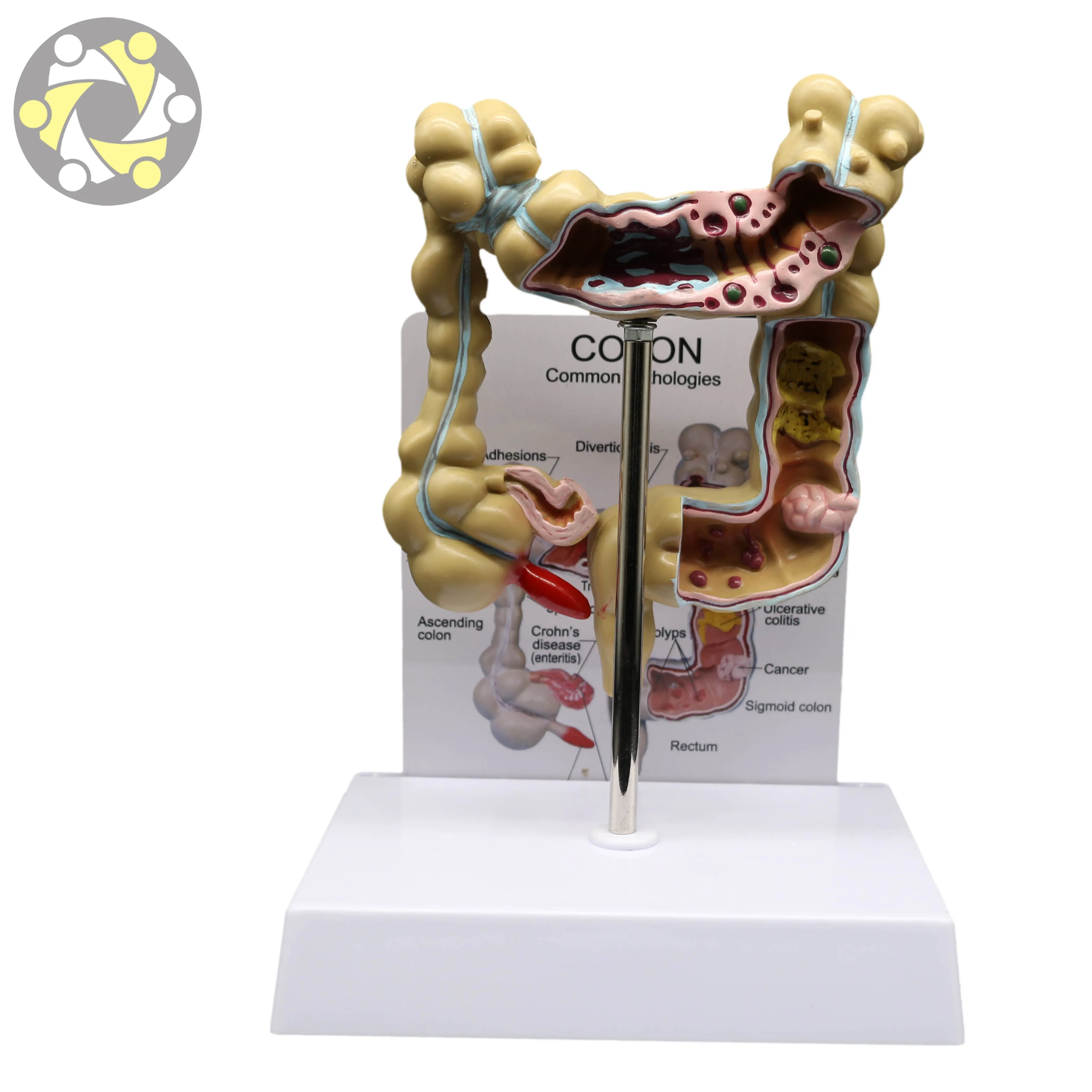 Advanced Diseased Large Intestines Model for Education Medical Science