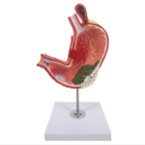 Modèle de Pathologie Gastrique D021F/D021G pour l'enseignement et l'apprentissage de l'Anatomie en Sciences Médicales pour la Formation des Infirmières - Product Image 4
