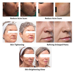 เครื่องเลเซอร์1927nm ทูลี่1927แบบไม่ผ่าตัดอยู่กับที่เครื่องทำเลเซอร์ผิวแบบ DIY - Product Image 6