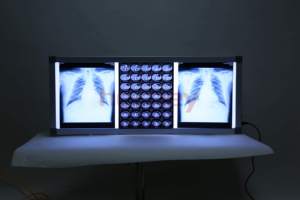 Ginee y tế <span class=keywords><strong>X</strong></span>-<span class=keywords><strong>Ray</strong></span> phim Viewer Bệnh viện Y tế LED <span class=keywords><strong>X</strong></span>-<span class=keywords><strong>Ray</strong></span> phim Viewer Bảng điều chỉnh duy nhất bệnh viện CT scan máy - Product Image 2