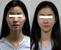 Saggy Skin V Line Vial, élimine le double menton, réduit les poches sous les yeux, lifting instantané du visage, raffermissant, lifting du visage en V