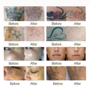 Máquinas Profesionales de Láser de Picosegundos para Eliminación de Tatuajes, Láser Pico Q-Switched Nd Yag - Product Image 6