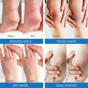 Crème pour les <span class=keywords><strong>pieds</strong></span> à fissures réparatrices et hydratantes en profondeur Produits de soin des <span class=keywords><strong>pieds</strong></span> anti-fissure Crème à l'urée pour les <span class=keywords><strong>pieds</strong></span> cassés - Product Image 6