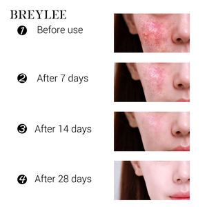 Crème à l'arbre à thé BREYLEE, marque privée, pour éliminer les taches brunes, l'acné, les boutons, réparer la peau, crème pour le <span class=keywords><strong>visage</strong></span>, 20g - Product Image 5