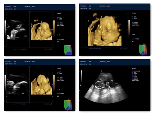 15 inch <strong>Colour</strong> <strong>Doppler</strong> Cardiac CW TDI Ultrasound Scanner Portable <strong>Echocardiography</strong> Machine - Product Image 4