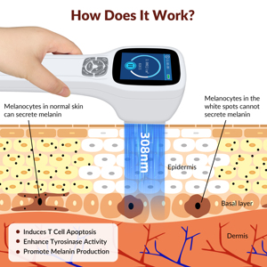 El Mejor Tratamiento Láser con Luz UVB Excimer de 308 nm para Vitiligo, Psoriasis, <span class=keywords><strong>Eczema</strong></span> y Enfermedades de la <span class=keywords><strong>Piel</strong></span> - Product Image 4