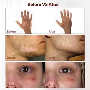 Dispositivo de Terapia de Luz Excimer de 308nm para el Tratamiento del Vitiligo, <span class=keywords><strong>Dermatitis</strong></span> Alérgica y Eczema Seco - Product Image 4