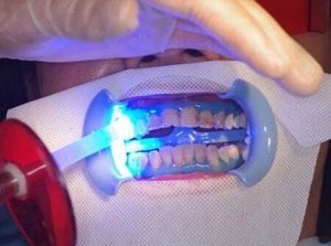 Cuidado bucal Blanqueamiento de dientes Cara Gasa Babero Máscara facial <span class=keywords><strong>dental</strong></span> con almohadilla de protección labial - Product Image 4
