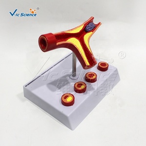 Modelo 3D de Congestión Vascular Bifurcada / Comparación de Estasis Venosa/Arterial por Edad, Entrenamiento de Simulación Médica, Alerta de Riesgo CVD - Product Image 2