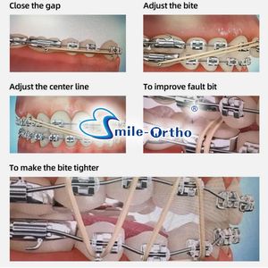 bandes de caoutchouc <span class=keywords><strong>orthodontique</strong></span> dentaire Ortho élastiques bande de Latex toutes les tailles élastiques inter-oraux - Product Image 6