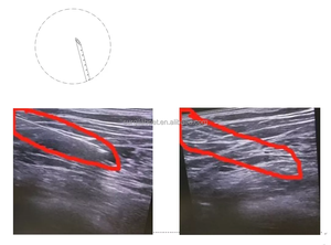 Ultrasound Guided Nerve Block Echogenic Nerve Block Needle Plexus Needle Visible Under Ultrasound Probe Disposable Anesthesia