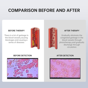Peluncuran Produk Baru Penjualan Langsung Pabrik: Perangkat yang Dapat Dipakai seperti Jam Tangan Laser 650nm/Strip Hidung/Kalung - Product Image 5