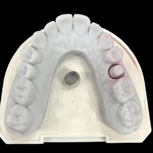 Prothèses dentaires et ponts métalliques de haute qualité <span class=keywords><strong>en</strong></span> forme de lustre métallique, laboratoire dentaire de Chine à bas <span class=keywords><strong>prix</strong></span> et de bonne qualité - Product Image 6