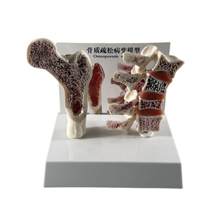 Mô hình bệnh lý loãng xương xương đốt sống của con người mô hình loãng xương xương đùi mô hình xương loãng xương - Product Image 1