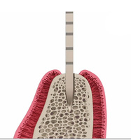 Fabricant chinois d'instruments dentaires NORER, instrument de forage dentaire utilisé pour la chirurgie implantaire dentaire, implant dentaire
