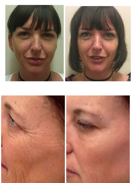 photomodulation therapy