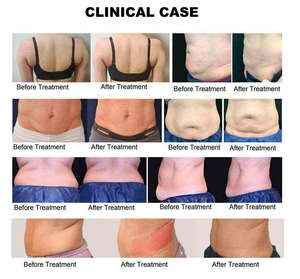 Nueva Máquina 2 en 1 Trusculpt ID para Adelgazamiento, Cutera Trusculpt Flex 2 en 1 para Moldear el Cuerpo, para Salón de Belleza, ABS Monopolar Trusculpt - Product Image 4