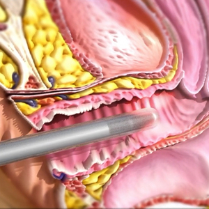 Chất lượng cao tối thiểu xâm lấn 980nm + 1470nm gynecologyvaginal thắt chặt laser điều trị cụ - Product Image 6