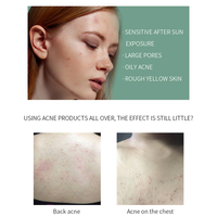 Portable Visage Brume Organique Acide Glycollique Huile D'arbre À Thé Anti Acné Dos Corps Visage Toner Brume Visage Spray